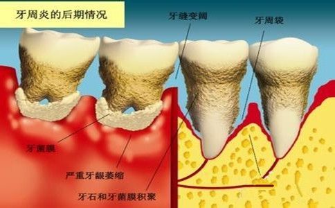 牙周炎吃什么药好得快？