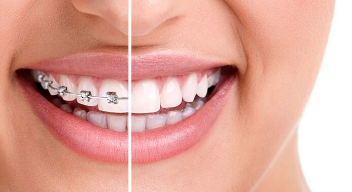 牙齿矫正的最佳年龄是多少？