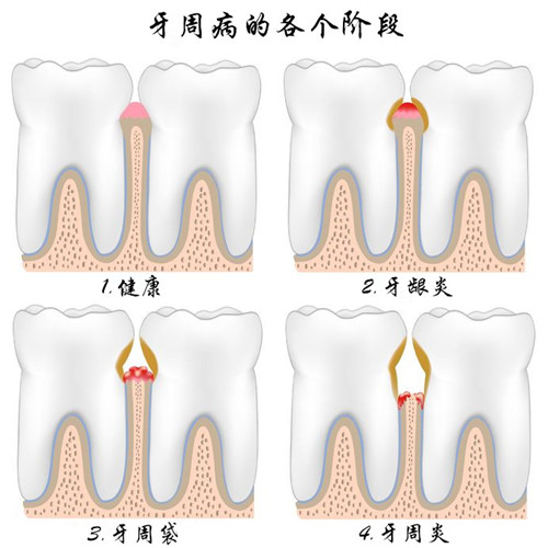 慢性牙周炎的危害有哪些？