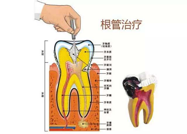 补牙必须根管治疗吗？