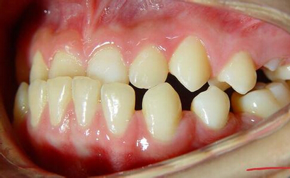 牙龈出血可能是牙髓炎