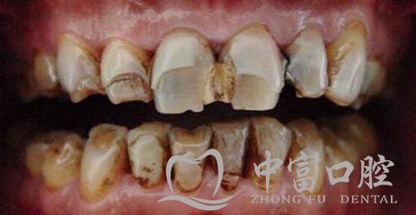 漳州市民如何在生活中预防烟渍牙