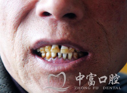 漳州烟渍牙有什么危害