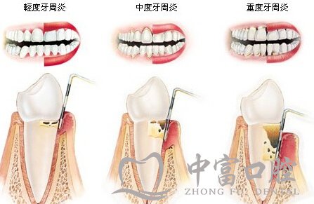 牙周病到底是如何形成的？