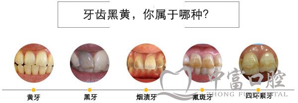 如何区别四环素牙和氟斑牙？